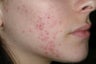Acne and Isolaz