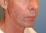 Jaw Augmentation w/ Mandibular Implants