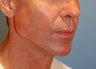 Jaw Augmentation w/ Mandibular Implants