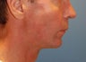 Jaw Augmentation with Mandibular Implants