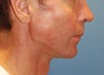 Jaw Augmentation with Mandibular Implants