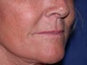 Juvederm to corners of the mouth and Botox to DAO