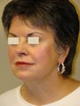 Juvederm Injections for midface