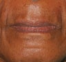 Juvederm