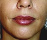 Lip Augmentation with Juvederm