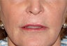Juvederm for Lip Border and Lip Lines