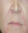 Juvederm