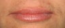 Juvederm to Lips