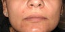 Juvederm