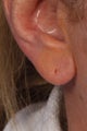 Juvederm Ultra Plus to Earlobes