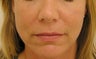 Juvederm