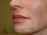 Juvederm Injection to Augment Lip Line