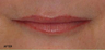 Juvederm - Upper and Lower Lip