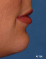 Juvederm Filler to Uppper and Lower Lip