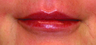 Lip augmentation