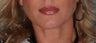 Lip Augmentation with Juvederm