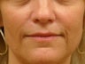 Treatment of prominent nasolabial folds with dermal filler