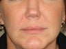 Treatment of prominent nasolabial folds with a dermal filler