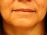 Treatment of marionette lines with a dermal filler