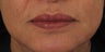 Juvederm