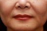 Injectable Filler