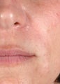 Juvederm 