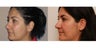 Facial Rejuvenation, non-surgical