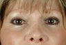 Juvederm