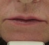 63 year old lip Augmentation with Juvederm