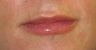 Juvederm