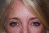 Juvederm