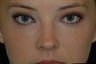Juvederm injected under the eyes