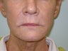 Juvederm