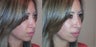 Smile lines treated with Juvederm