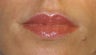 Juvederm