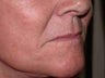 Juvederm to corners of the mouth and Botox to DAO
