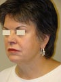 Juvederm Injections for midface