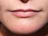 Lip augmentation