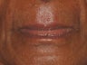 Juvederm