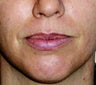 Lip Augmentation with Juvederm