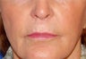 Juvederm for Lip Border and Lip Lines