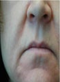 Juvederm