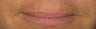 Juvederm to Lips