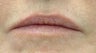 Juvederm