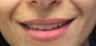 Juvederm