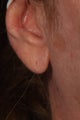 Juvederm Ultra Plus to Earlobes