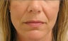 Juvederm