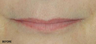 Juvederm - Upper and Lower Lip