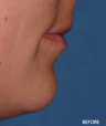 Juvederm Filler to Uppper and Lower Lip