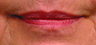 Lip augmentation